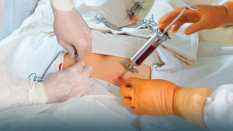 Bone Marrow Transplant Market – Industry Trends and Forecast