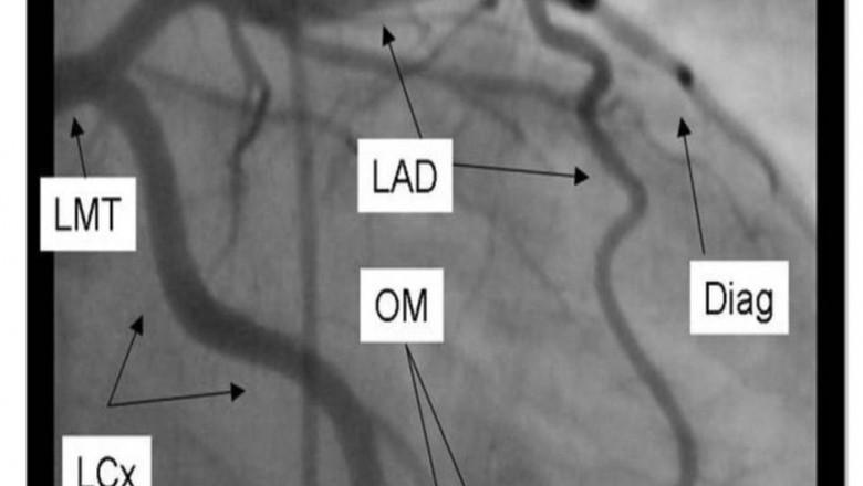 NATURAL TREATMENT OF BERNARD SOULIER SYNDROME