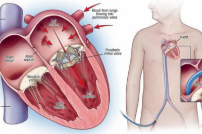 In the treatment of severe mitral regurgitation, Transcatheter Mitral Valve Repair and Replacement may be used as an alternative therapeutic option