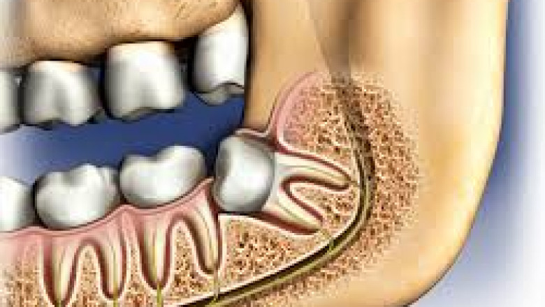 Wisdom Tooth Removal Procedure