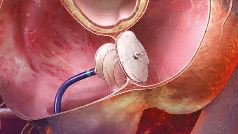 Patent Foramen Ovale (PFO) Closure Devices Market Poised To Garner Maximum Revenues During 2027