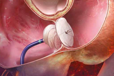Patent Foramen Ovale (PFO) Closure Devices Market Poised To Garner Maximum Revenues During 2027