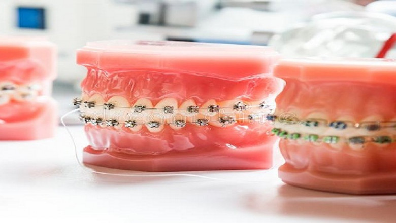 What Do You Expect From a Dental Crown Procedure?