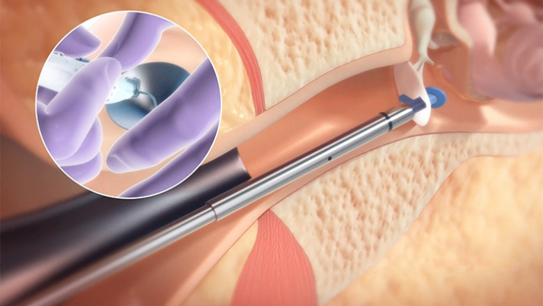 Ear Tube Devices Market 2021 Comprehensive Analysis, Business Growing Strategies, Industry Segmentation and Forecast 2028