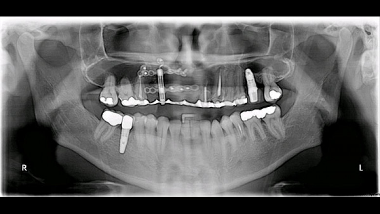 Distraction Osteogenesis Devices Market Size 2021 By Analysis, Manufacturers, Regions, Type and Application, and Forecasts to 2027