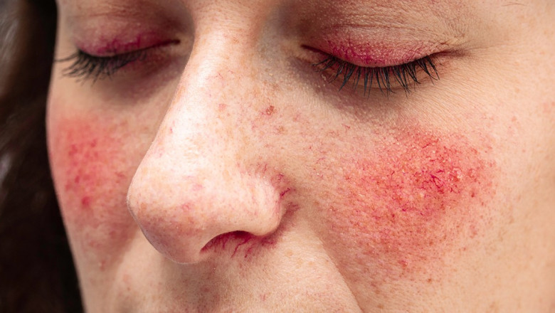 How to clear rosacea?