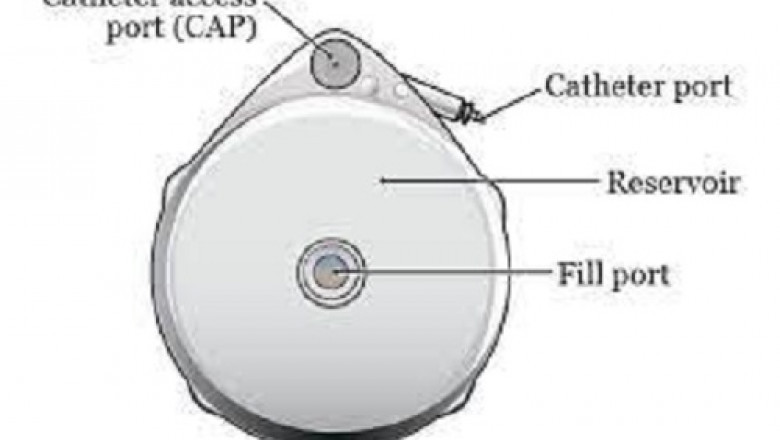 Implantable Infusion Pumps Market research by dbmr forecast to 2028