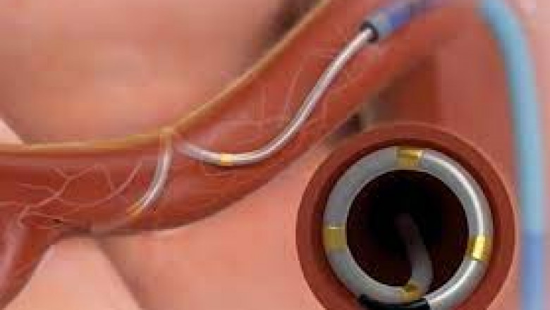 Renal Denervation Devices Market Size, Share & Trends Analysis Report