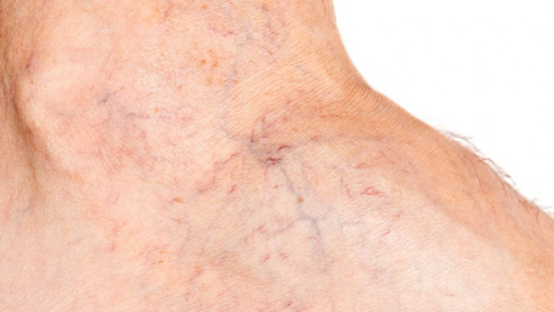 Spider Vein Treatment Center Near Me