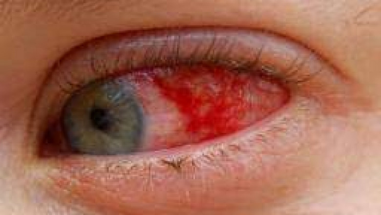 Uveitis Treatment Market- Growth, Challenges and Future Scope