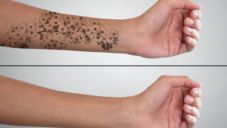 Can tattoo be removed naturally?