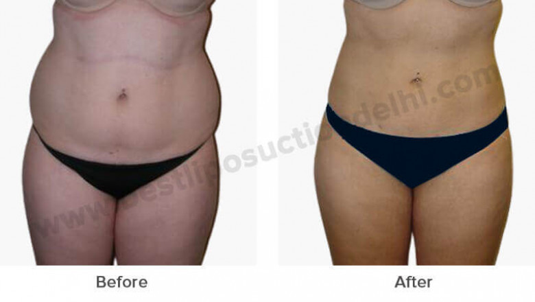 Liposuction surgery in Delhi at LA Clinic