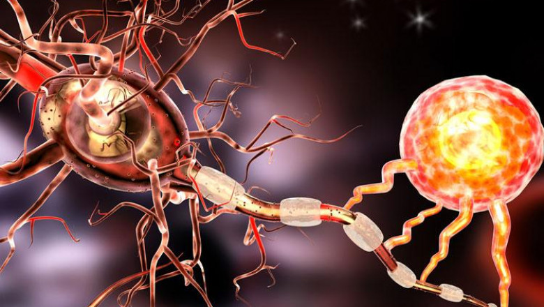 The Most Successful Treatment Protocol Involves The Use Of Multiple Sclerosis Therapeutics Formulated Using Antineoplastic Agents