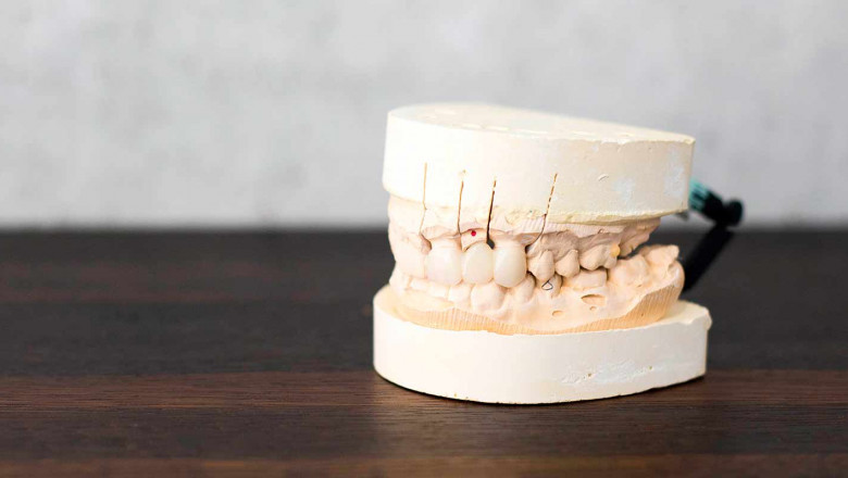 What to Do After Tooth Extraction – The Do's and Don'ts
