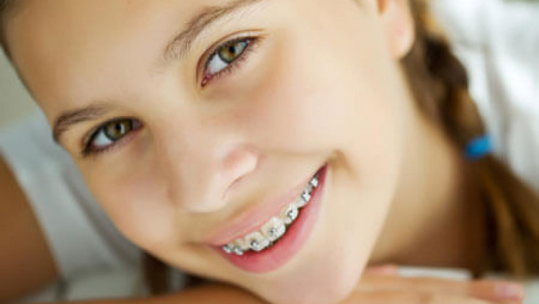 Where Can You Get Invisalign Treatment In Brooklyn?