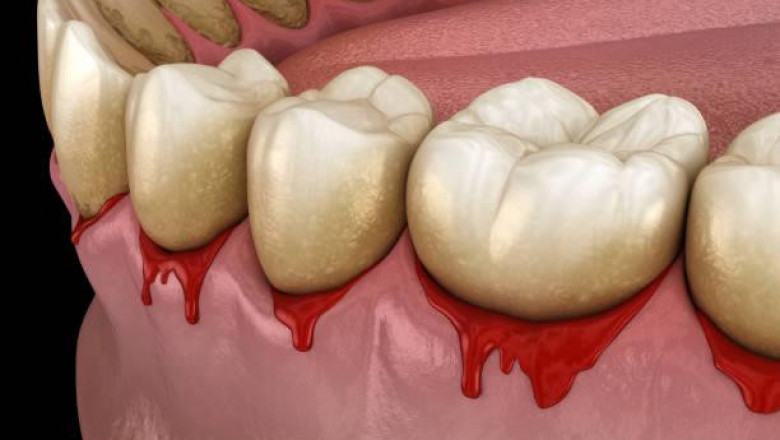 Which Procedures Treat Gum Disease?