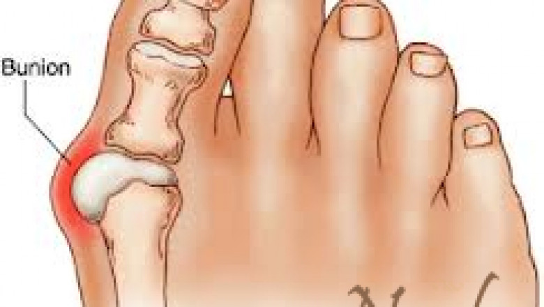 Bunions Treatment In Huston