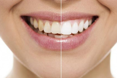 All You Need To Know About Dental Implants