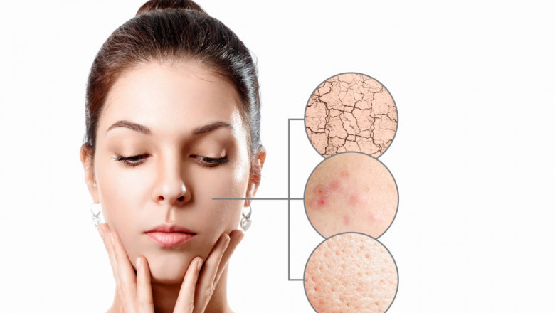 How Can A Skin Specialist in KL Help With Acne Scar Treatment?