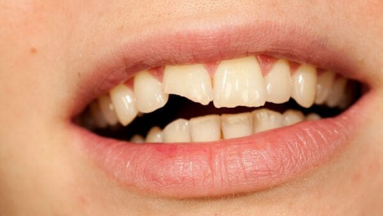 Does A Cracked Tooth Require An Emergency Dentist Visit?