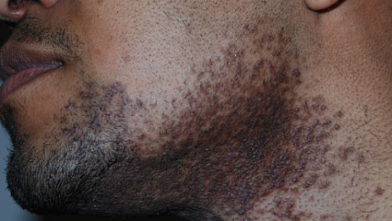 Pseudofolliculitis Barbae Market 2021 - Top Manufacturers, Latest Trends, Future Prospects and Forecast 2028