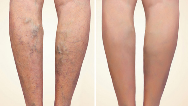 The Global Varicose Vein Treatment Market Is Divided Into Three Categories Based On End User: Hospitals, Clinics, And Home Use