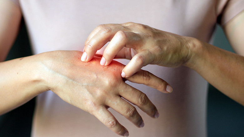 Various Ways To Do Systemic Scleroderma Treatment.