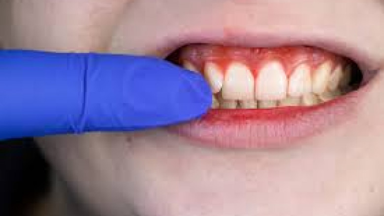 Gingival Recession: Frequently Asked Questions