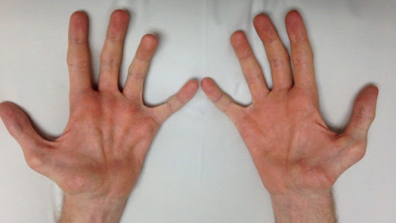 Charcot-Marie-Tooth disease is a chronic, inherited peripheral neuropathy.