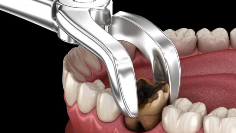 Get Affordable Teeth Whitening Treatment at a Trusted Dental Clinic