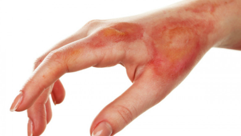 Recognizing, Preventing, and Treating Radiodermatitis