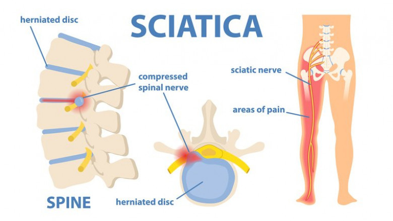 Pain from sciatica can be described in different ways, depending on the cause.