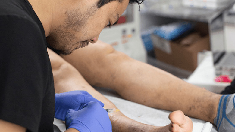 Spider Vein Treatment: How to get rid of recurring ugly veins?