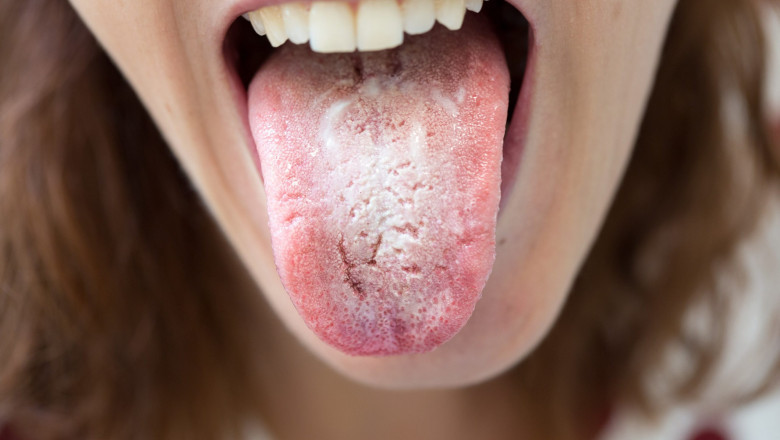 What causes Candidiasis of the skin?