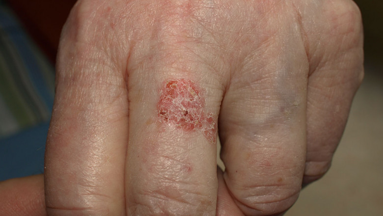 Bowen Disease Treatment: What You Need To Know