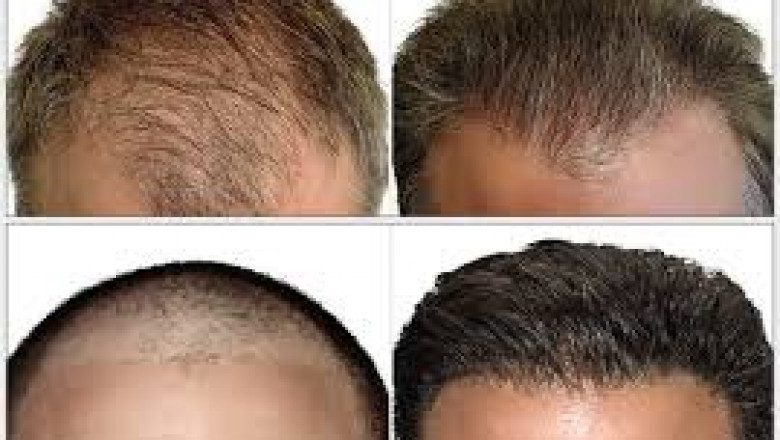Is Hair Transplant Surgery Perfect in Summer?
