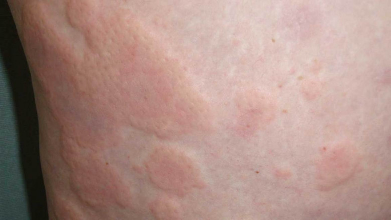 Hives treatment Market 2021 | Demand and Scope with Outlook, Business Strategies, Challenges and Forecasts to 2028