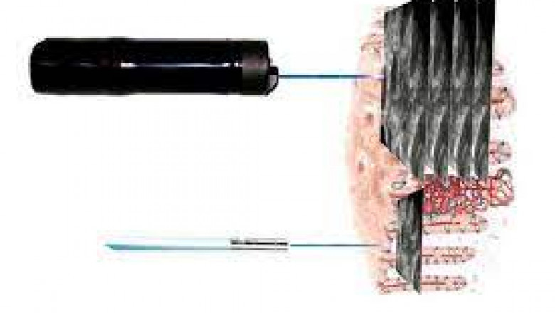 Laser Endomicroscopy Market 2021 Company Overview, Recent Developments and SWOT Analysis 2028