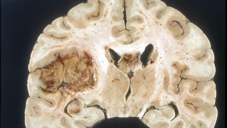 Glioblastoma Multiforme Treatment Industry See Huge Growth for New Normal | Research Informatic