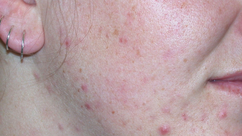 What Is Acne? Symptoms, Causes, Treatments