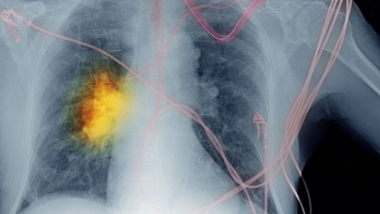 Europe Non-Small Cell Lung Cancer Diagnostics Market to Experience Significant Growth during the Forecast Period 2021-2028
