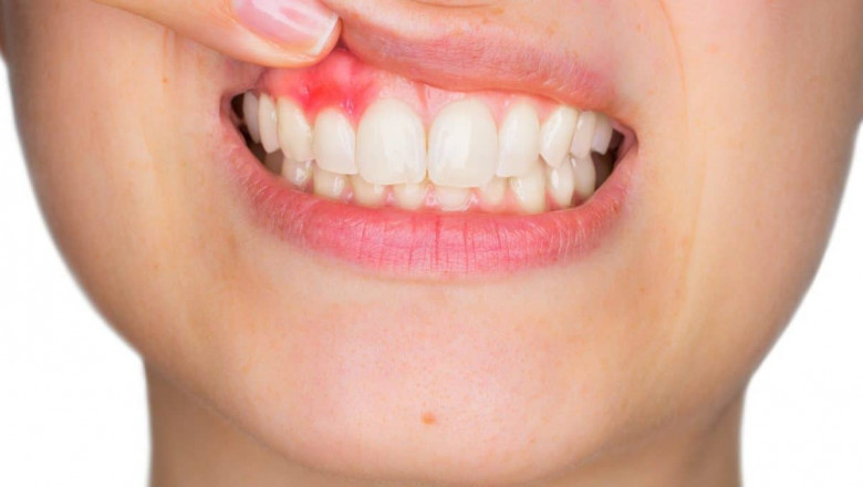 Everything You Need To Know About Is Tooth Abscess!