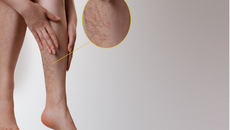 How Should I Eliminate My Varicose Veins Without Surgery?