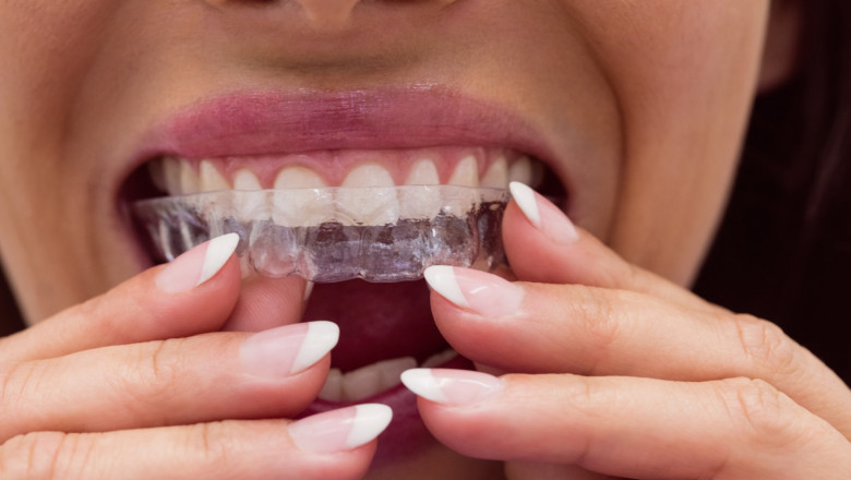 Invisalign Treatment Process – The 5 Stages