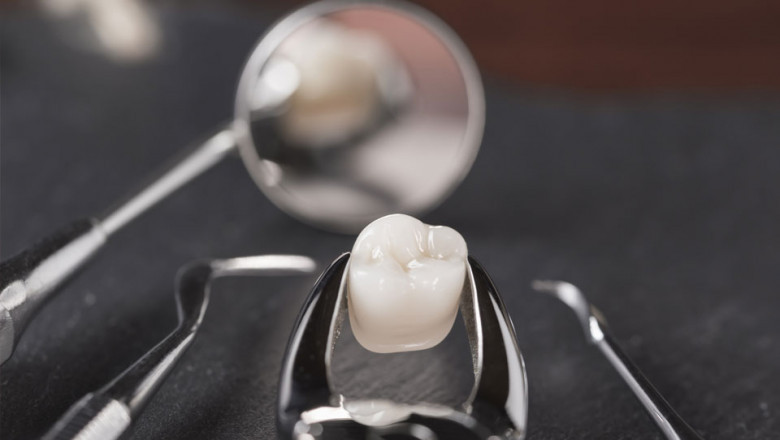 Tooth Extraction: Do You Need It?