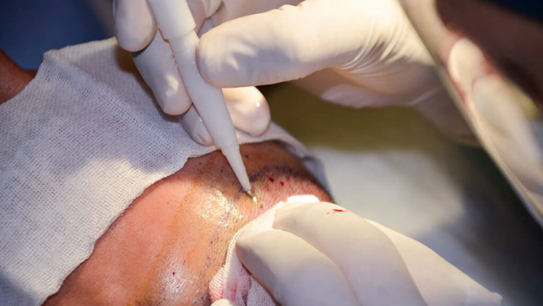 When does Hair grow After Hair Transplant Surgery?