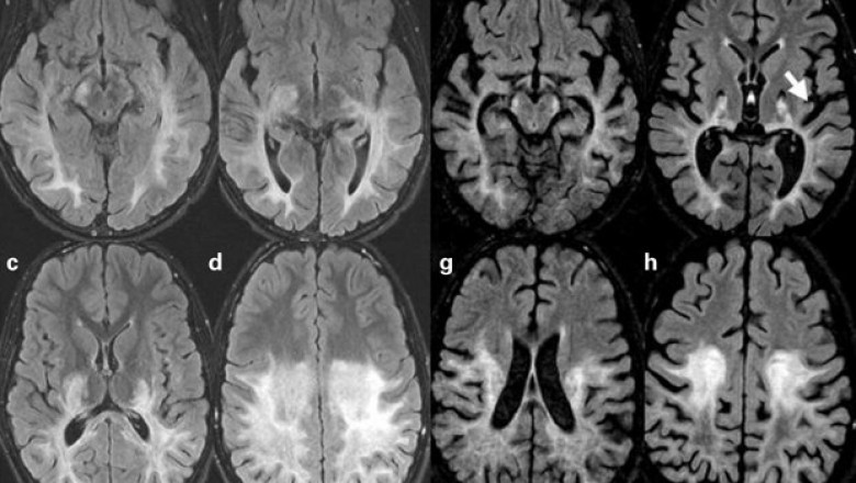 Cerebral Adrenoleukodystrophy Treatment Market 2021 Growth, Latest Trend Analysis and Forecast 2028