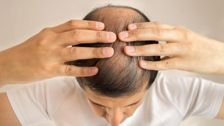 How To Get The Effective Hair Transplant in India?