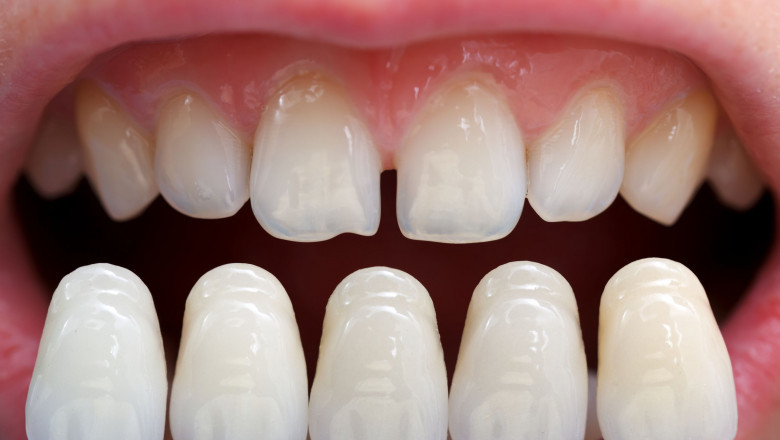 What Do You Need To Know About The Teeth Cleaning Cost?