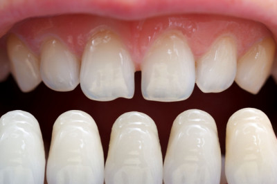 What Do You Need To Know About The Teeth Cleaning Cost?